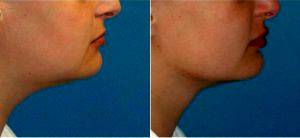 34 Year Old Woman Treated With Liposuction Of The Neck With Doctor Scott C. Sattler, MD, FACS, Seattle Plastic Surgeon