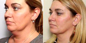 35 Year Old Woman Treated With Chin Liposuction By Dr. Charles R. Nathan, MD, FACS, Saint Louis Plastic Surgeon