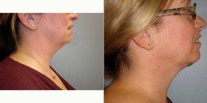 43 Year Old Woman Treated With Chin Liposuction By Doctor Heather Rocheford, MD, Minneapolis Plastic Surgeon