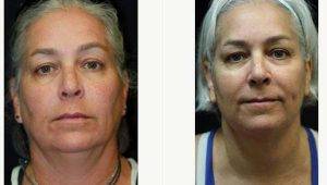 50 Year Old Woman Treated With Chin Liposuction By Dr Kris M. Reddy, MD, FACS, West Palm Beach Plastic Surgeon