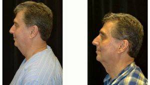 59 Year Old Man Treated With Kybella With Dr Christopher J. Davidson, MD, FACS, Boston Plastic Surgeon