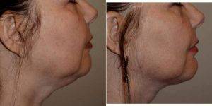 59 Year Old Woman Treated With Chin Liposuction By Dr Scott K. Thompson, MD, Salt Lake City Facial Plastic Surgeon