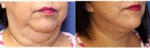 61 Year Old Woman With Neck Liposuction By Dr. David N. Hing, MD, Ann Arbor Plastic Surgeon