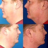 Chin Lipo Alternative Before And After Photos