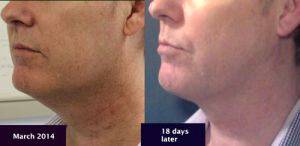 Chin Lipo Before And After With Dr. Phillip C. Haeck, Seattle Plastic Surgeon