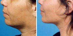 Chin Liposuction Before After By Dr George Commons, MD, Palo Alto Plastic Surgeon