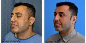 Chin Liposuction Before And After With Dr. Ali Sajjadian, MD, FACS, Orange County Plastic Surgeon