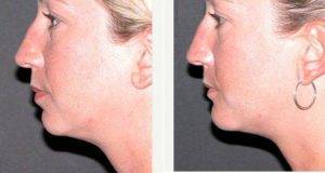 Chin Liposuction By Doctor Thomas Fiala, MD, Orlando Plastic Surgeon