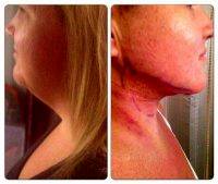 Chin Liposuction Fort Lauderdale Before And After Photos