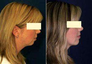 Chin Neck Liposuction With Doctor Ricardo L. Rodriguez, MD, Baltimore Plastic Surgeon