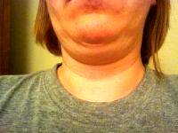 Do Double Chin Exercises Work