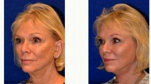 Doctor Ali Sajjadian, MD, FACS, Orange County Plastic Surgeon - Neck Liposuction Before And After