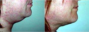 Doctor Allen Rezai, MD, London Plastic Surgeon - 37 Year Old Woman Treated With Chin Liposuction Double Chin Correction