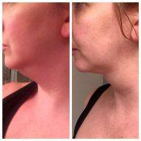 Doctor Lauren Greenberg, San Jose Plastic Surgeon Chin Liposuction Before And After