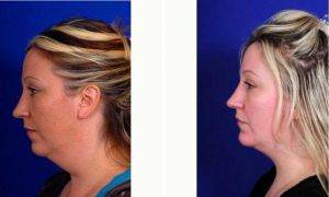 Doctor Michel Siegel, MD, Houston Facial Plastic Surgeon - 42 Year Old Woman Treated With Chin Liposuction