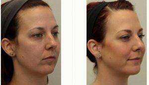 Doctor Parker A. Velargo, MD, New Orleans Facial Plastic Surgeon - 25 Year Old Woman Treated With Liposculpture