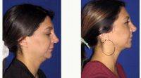 _Double Chin_ Correction With Smart Lipo By Dr Anthony Corrado, DO, Philadelphia Facial Plastic Surgeon 873