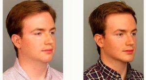 Dr Donald Nunn, MD, Atlanta Plastic Surgeon - 20 Year Old Man Treated With Chin Liposuction
