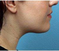 Dr Kathleen L. Behr, MD, Fresno Dermatologist - 21 Year Old Woman Treated With Chin Liposuction
