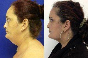 Dr Rami Ghurani, MD, Miami Plastic Surgeon - 39 Yo Female Treated For Excess Neck Fat