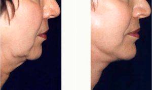 Dr Richard H. Bensimon, MD, Portland Plastic Surgeon - 55-64 Year Old Woman Treated With Liposuction