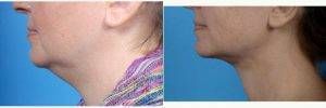 Dr Robert Brobst, MD, Dallas Facial Plastic Surgeon - 41 Year Old Women, Face And Neck Liposuction