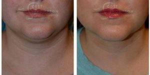 Dr Scott K. Thompson, MD, Salt Lake City Facial Plastic Surgeon - 43 Year Old Woman Treated With Chin Liposuction