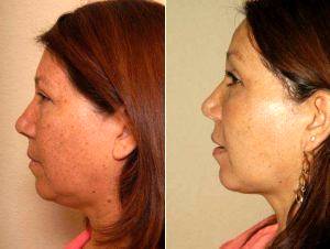 Dr. Christian G. Drehsen, MD, Tampa Plastic Surgeon - Liposuction Of The Neck 389