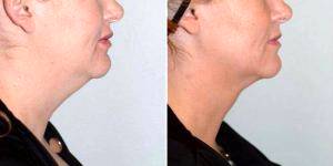 Dr. Elisa A. Burgess, MD, Portland Plastic Surgeon - 36 Year Old Woman Treated With Chin Liposuction