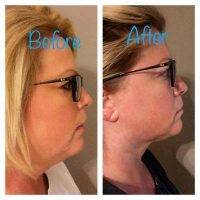 Dr. Elizabeth S. Harris, San Antonio Plastic Surgeon Chin Liposuction