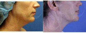 Dr. Kyle Coleman, MD, New Orleans Dermatologic Surgeon - 47 Year Old Woman Treated With Chin Liposuction