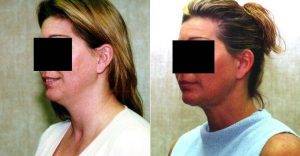 Dr. Sean Younai, MD, FACS, Beverly Hills Plastic Surgeon - Liposuction Of Neck Jaw Line For Women