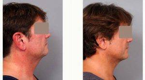 Dr. Thomas P. Sterry, MD, New York Plastic Surgeon - 54 Year Old Man Treated With Chin Liposuction
