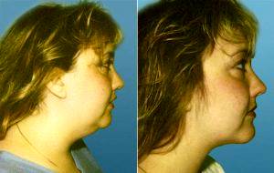 Lipoplasty - Neck After Before By Doctor Stephen Kay, MD, Washington DC Plastic Surgeon