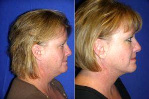 Liposuction Of Neck By Doctor Manish H. Shah, MD, FACS, Denver Plastic Surgeon