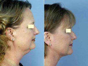 Liposuction Of The Neck Before & After By Dr Louis M. DeJoseph, MD, Atlanta Facial Plastic Surgeon