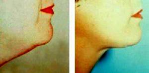 Liposuction Of The Neck By Dr. Gary H. Manchester, MD , San Diego Plastic Surgeon