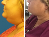 Neck & Chin Liposuction Before And After Photos