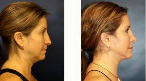 Woman Treated With Liposuction Of The Neck Before And after By Dr. Jose M. Soler-Baillo, MD, Miami Plastic Surgeon