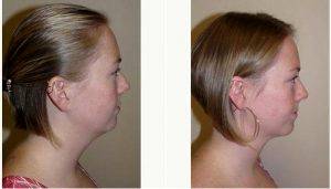 Woman Treated With Liposuction With Doctor Itzhak Nir, MD, FACS, West Palm Beach Plastic Surgeon