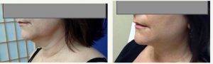 36 Year Old Woman Treated With Laser Liposuctionof Chin With Doctor Gregory Chambon, MD, Overland Park Family Physician