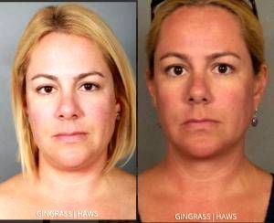 38 year old female patient desires contouring of chin by Dr. Mary Gingrass, Nashville, TN Plastic Surgeon (1)