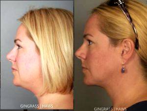 38 year old female patient desires contouring of chin by Dr. Mary Gingrass, Nashville, TN Plastic Surgeon (2)