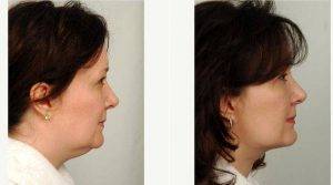 55 Year Old Female Submental Liposuction Procedure Before & After With Dr. R. Scott Yarish, MD, Houston Plastic Surgeon
