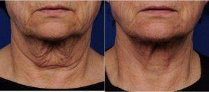 61 Year Old Woman Treated With Laser Liposuction PreOp & PostOp By Dr. Girish S. Munavalli, MD, MHS, Charlotte Dermatologic Surgeon