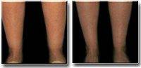 Ankles Lipo With Doctor George Lefkovits, MD - New York Plastic Surgeon