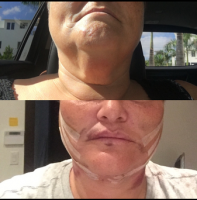 Chin Lipo Before And After By Dr Donald Altman, MD