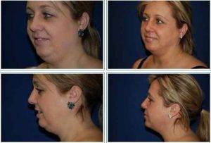 Chin Lipo By By Dr. Andrew Giacobbe Buffalo NY Plastic Surgeon (1)
