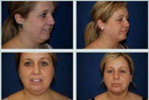 Chin Lipo By By Dr. Andrew Giacobbe Buffalo NY Plastic Surgeon (2)