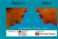 Chin Lipo By Dr. Al Farabi L. Jaafar (NEU Advanced Aesthetics), Plastic Surgeon In Makati, Philippines